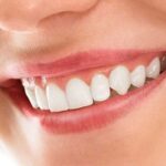 porcelain veneers near you