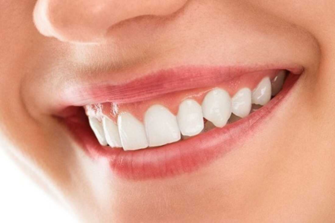 porcelain veneers near you